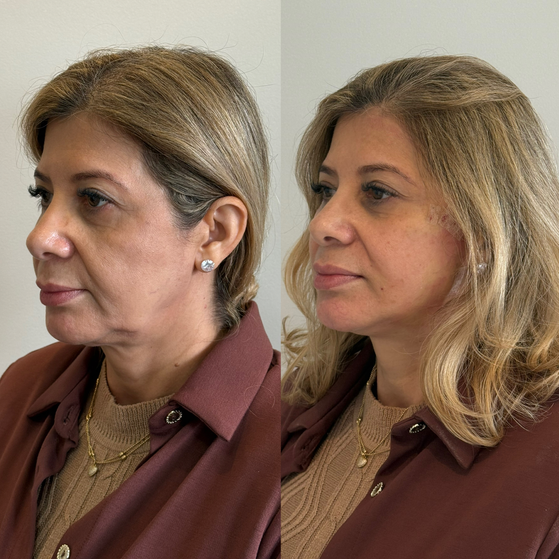 Resultado de cliente — antes e depois